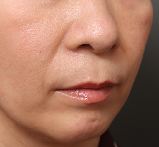 40代女性の人中短縮（リップリフト） Before 症例写真