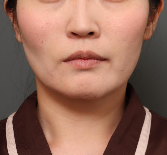 30代女性の顔の脂肪吸引 After 症例写真