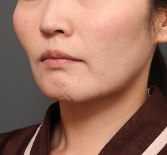 30代女性のバッカルファット除去 After 症例写真
