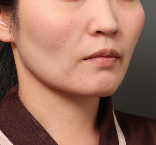 30代女性のバッカルファット除去 After 症例写真