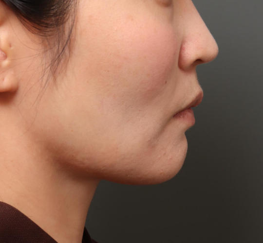 30代女性のバッカルファット除去 After 症例写真