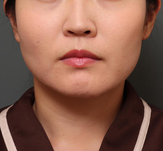 30代女性の顔の脂肪吸引 Before 症例写真