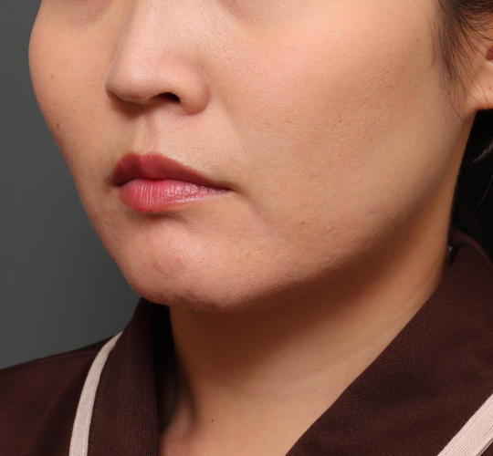 30代女性のバッカルファット除去 Before 症例写真