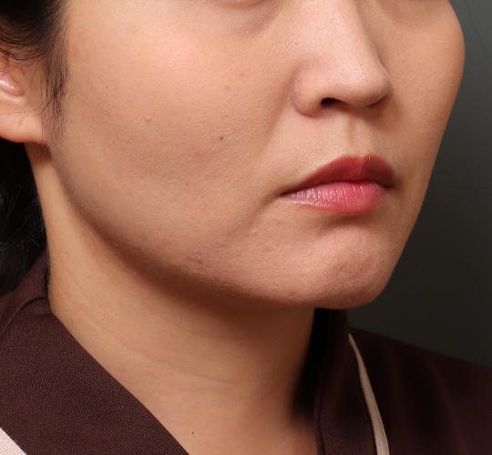 30代女性のバッカルファット除去 Before 症例写真