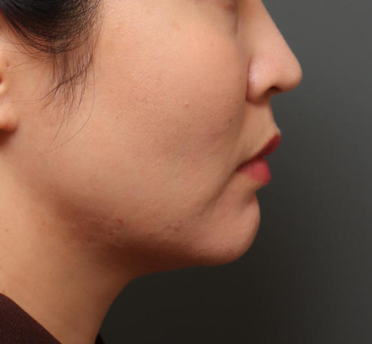 30代女性のバッカルファット除去 Before 症例写真