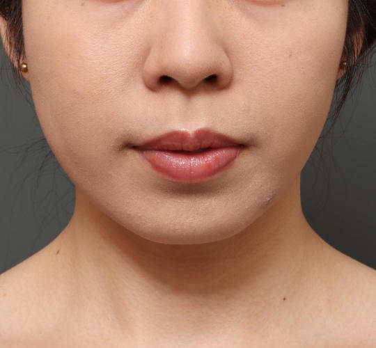 20代女性のメーラーファット除去 After 症例写真