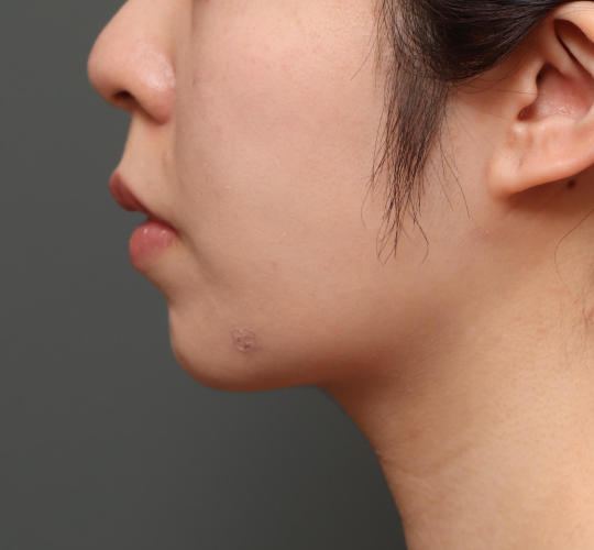 20代女性の顔の脂肪吸引 After 症例写真