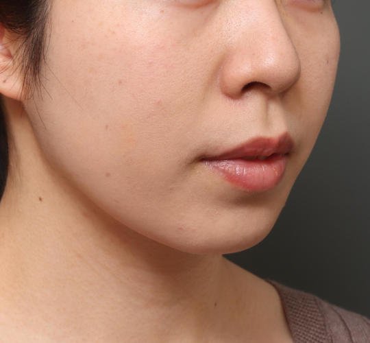 20代女性のメーラーファット除去 After 症例写真