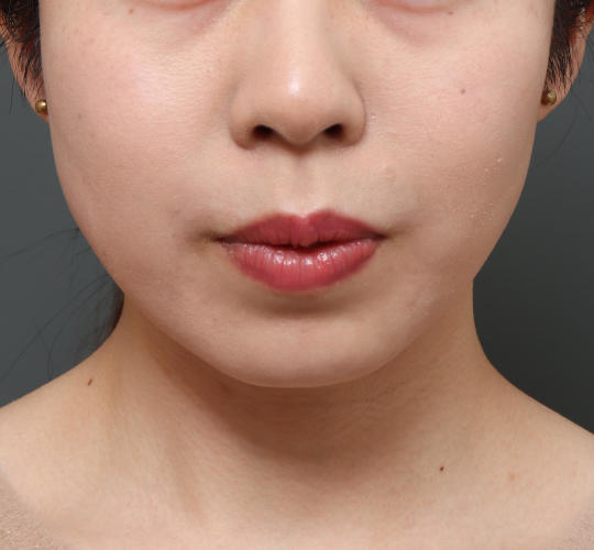 20代女性のメーラーファット除去 Before 症例写真