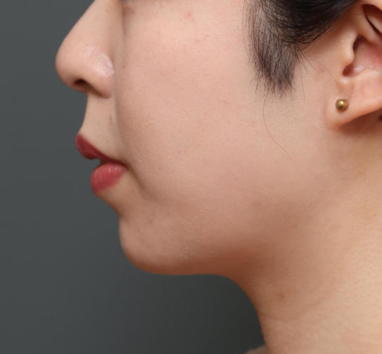 20代女性の顔の脂肪吸引 Before 症例写真