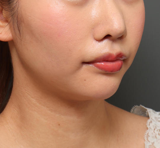 20代女性の人中短縮（リップリフト） After 症例写真