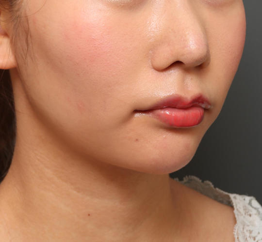 20代女性の人中短縮（リップリフト） Before 症例写真