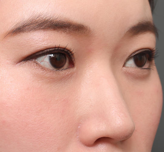 30代女性の目頭切開 Before 症例写真