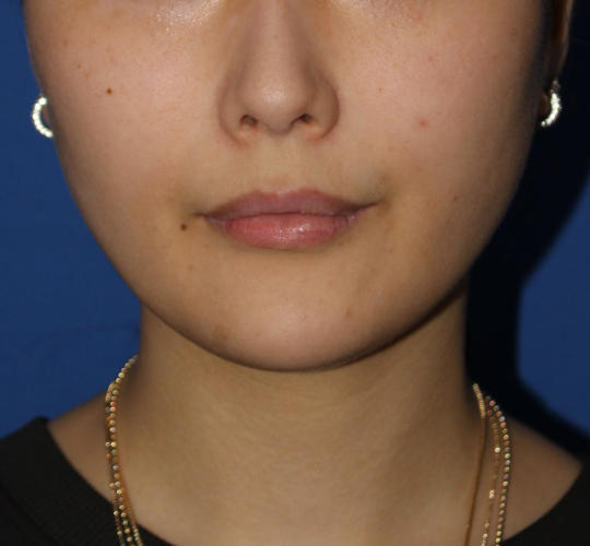 20代女性のVOVリフトプレミアム After 症例写真