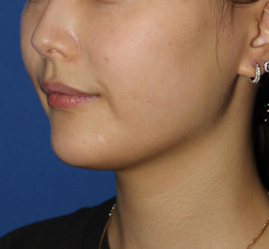 20代女性のVOVリフトプレミアム After 症例写真