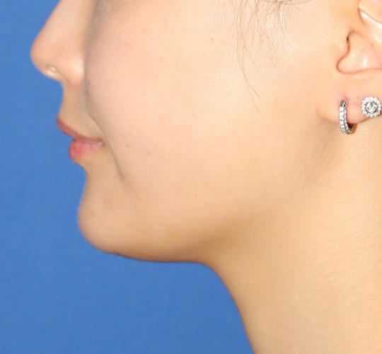 20代女性のVOVリフトプレミアム After 症例写真