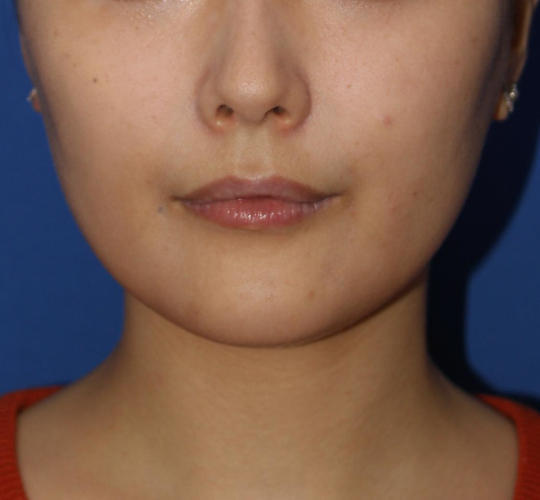 20代女性のVOVリフトプレミアム Before 症例写真