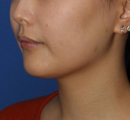 20代女性のVOVリフトプレミアム Before 症例写真