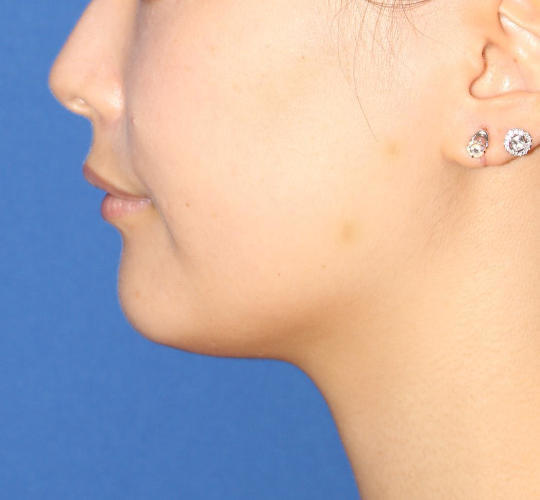 20代女性のVOVリフトプレミアム Before 症例写真