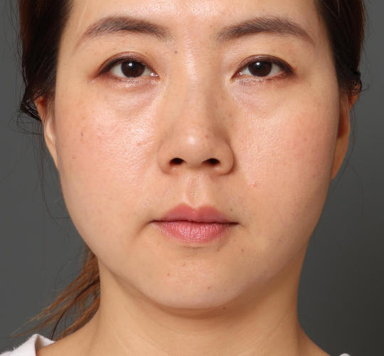 30代女性の顔の脂肪吸引  After 症例写真