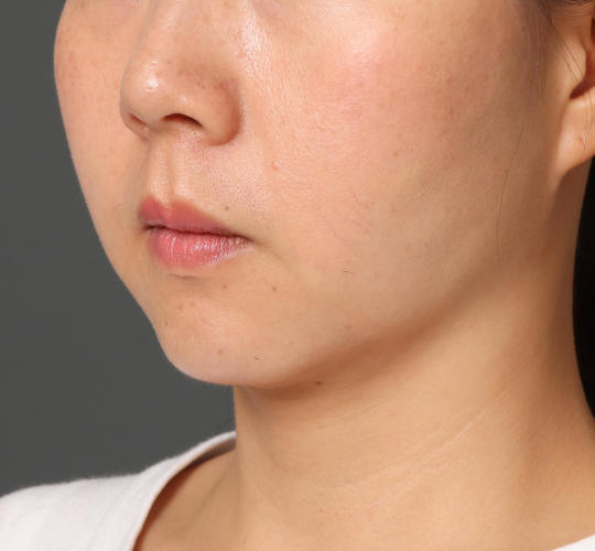 30代女性の顔の脂肪吸引 After 症例写真