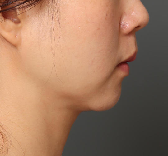 30代女性の顔の脂肪吸引  After 症例写真