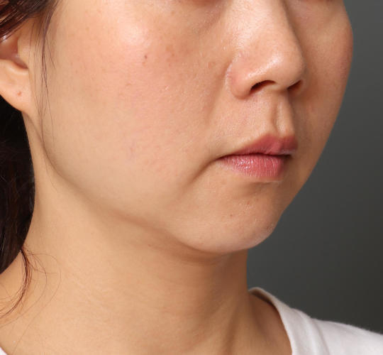30代女性の顔の脂肪吸引  After 症例写真