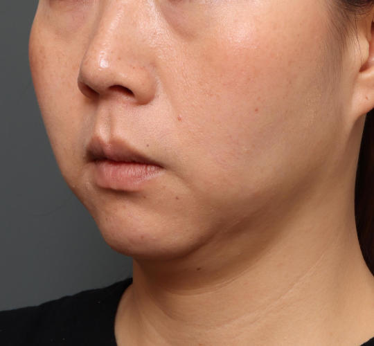 30代女性の顔の脂肪吸引 Before 症例写真
