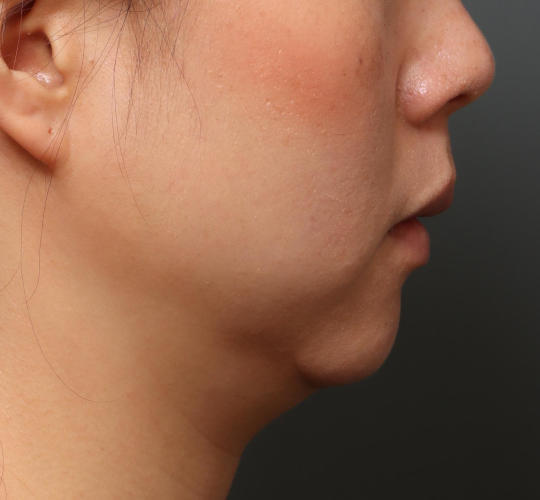 30代女性の顔の脂肪吸引  Before 症例写真