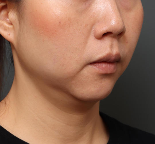 30代女性の顔の脂肪吸引  Before 症例写真