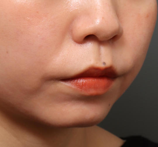 20代女性の人中短縮（リップリフト） Before 症例写真