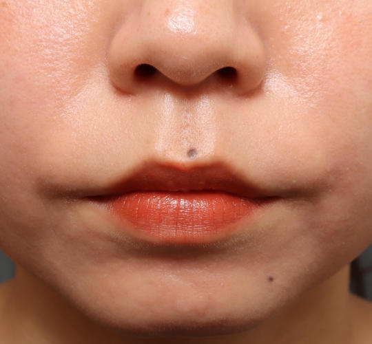 20代女性の人中短縮（リップリフト） Before 症例写真