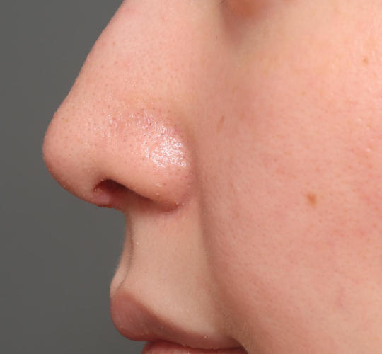 20代女性の鼻の整形 After 症例写真