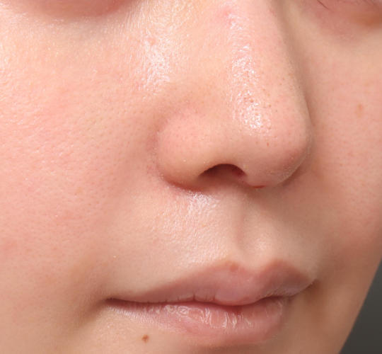 20代女性の耳介軟骨移植 After 症例写真