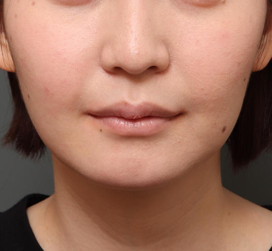 20代女性の耳介軟骨移植 Before 症例写真