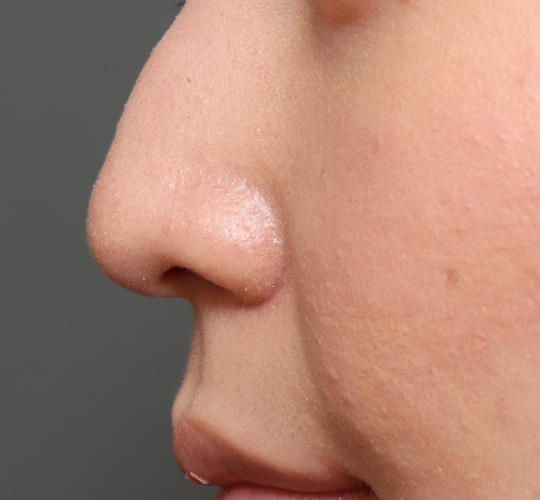20代女性の鼻の整形 Before 症例写真