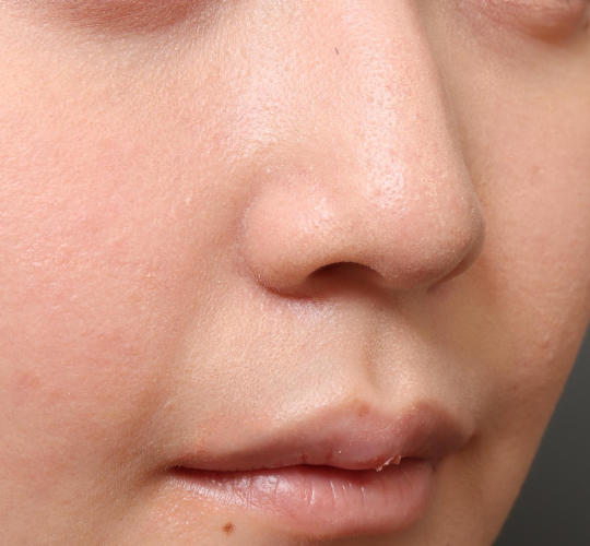 20代女性の耳介軟骨移植 Before 症例写真