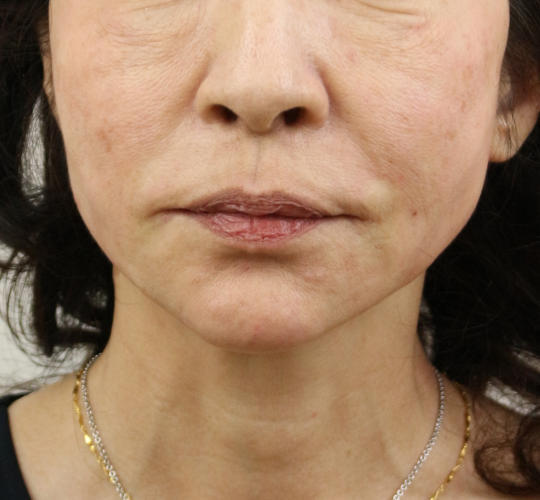 60代女性のVOVリフトプレミアム After 症例写真