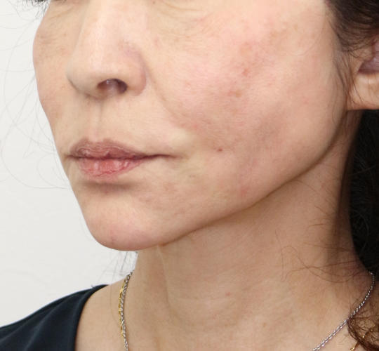 60代女性のVOVリフトプレミアム After 症例写真