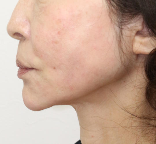 60代女性のVOVリフトプレミアム After 症例写真