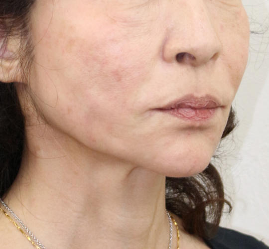 60代女性のVOVリフトプレミアム After 症例写真