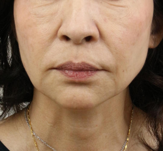 60代女性のVOVリフトプレミアム Before 症例写真