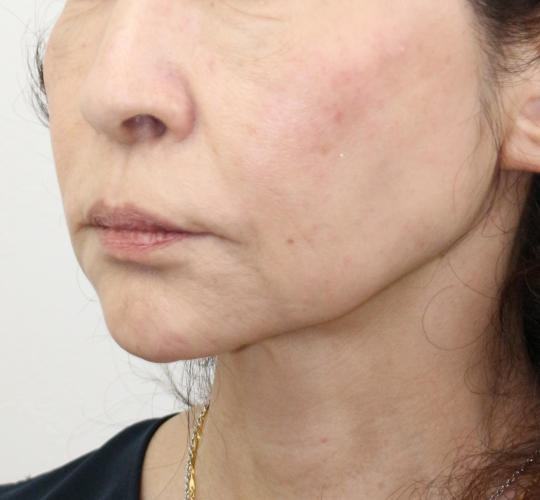 60代女性のVOVリフトプレミアム Before 症例写真