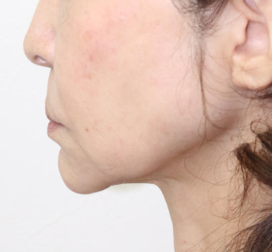 60代女性のVOVリフトプレミアム Before 症例写真