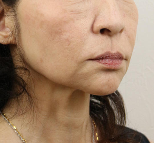 60代女性のVOVリフトプレミアム Before 症例写真