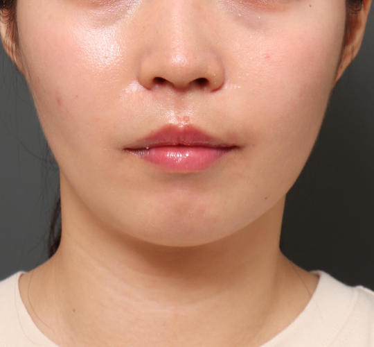 20代女性の人中短縮（リップリフト） After 症例写真