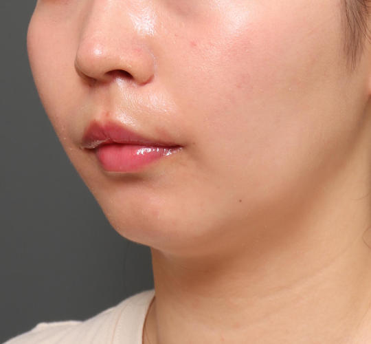 20代女性の人中短縮（リップリフト） After 症例写真