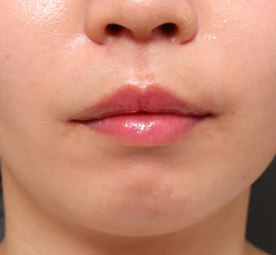 20代女性の人中短縮（リップリフト） After 症例写真