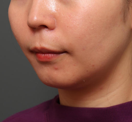 20代女性の人中短縮（リップリフト） Before 症例写真