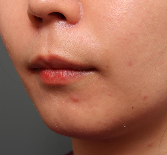 20代女性の人中短縮（リップリフト） Before 症例写真